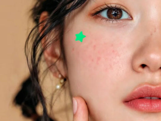 Skin Purging or a Breakout: How to Tell the Difference