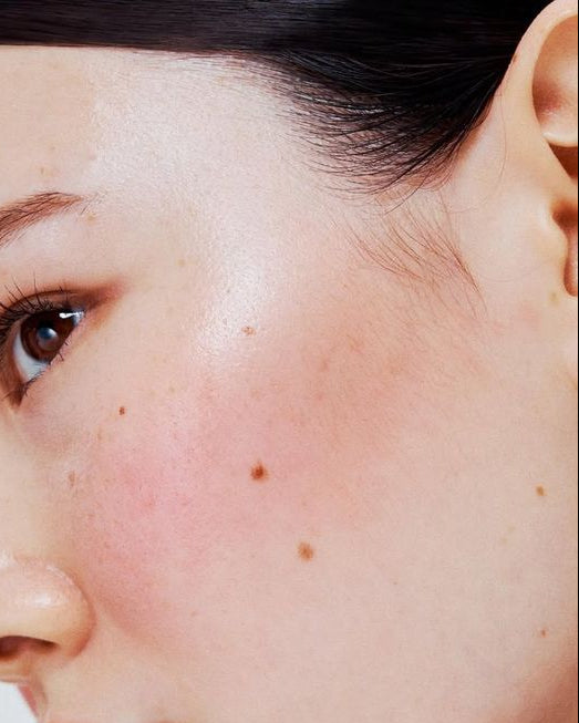 Pigmentation & Dullness