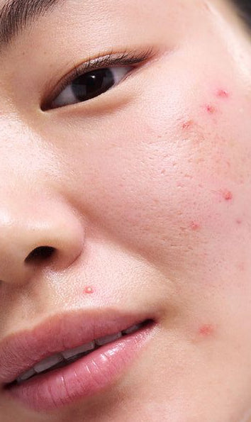 Acne & Breakouts