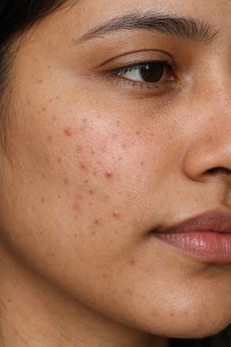 Acne & Breakouts