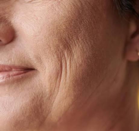 Fine Lines & Wrinkles