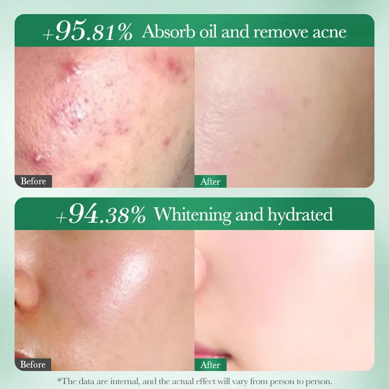Salicylic Acid Acne Cleanser for Clear Skin – SADOER 100g
